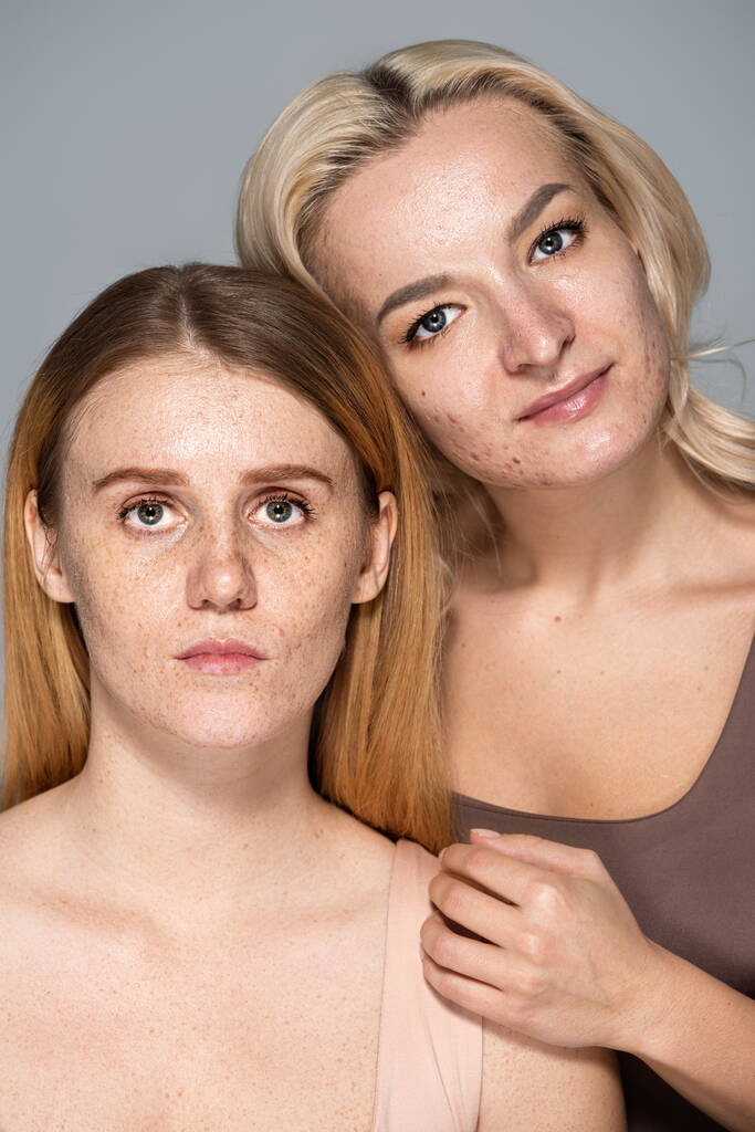 Vrouwen met acne en sproeten huid samen poseren geïsoleerd op grijs  - Foto, afbeelding