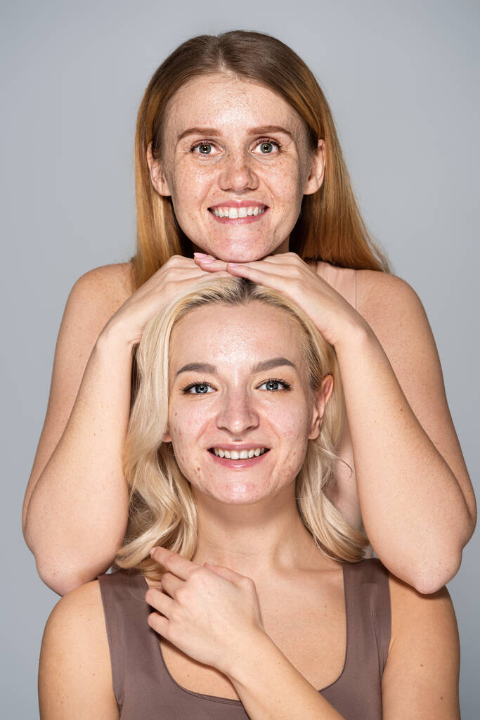 Mujer pecosa positiva posando cerca de un amigo con acné aislado en gris  - Foto, imagen
