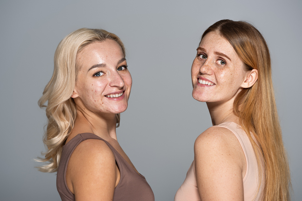 Positieve modellen met acne en sproeten kijken naar camera geïsoleerd op grijs  - Foto, afbeelding