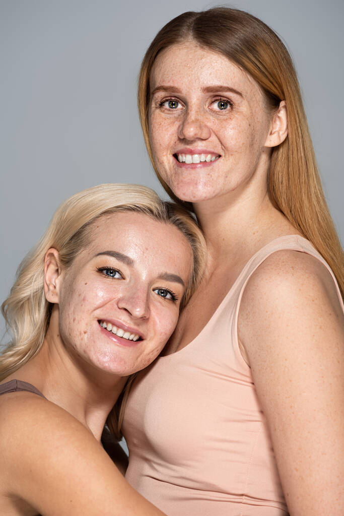 Веселые женщины с проблемами кожи, смотрящие в камеру, изолированную на сером  - Фото, изображение