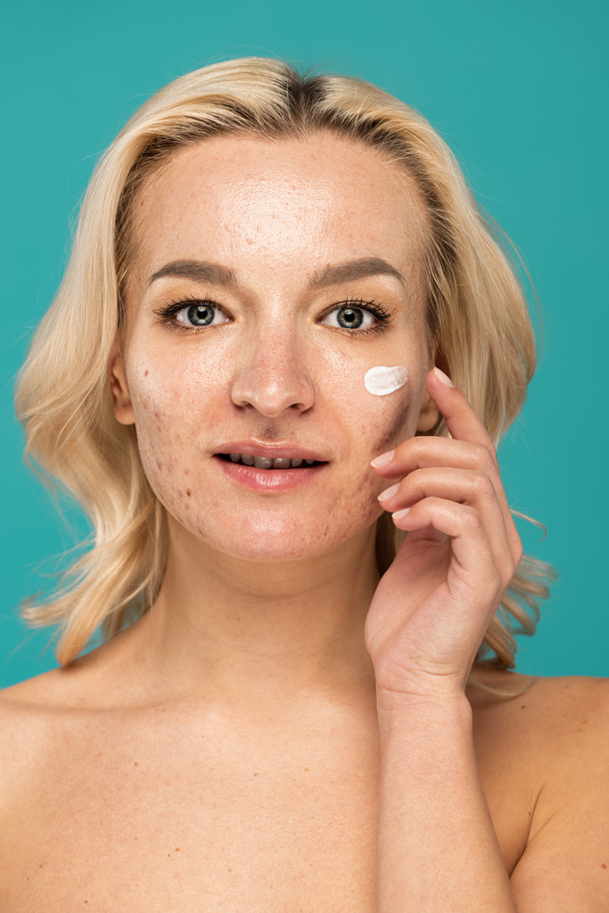 blonde woman with acne applying cream on face isolated on turquoise  - Photo, Image