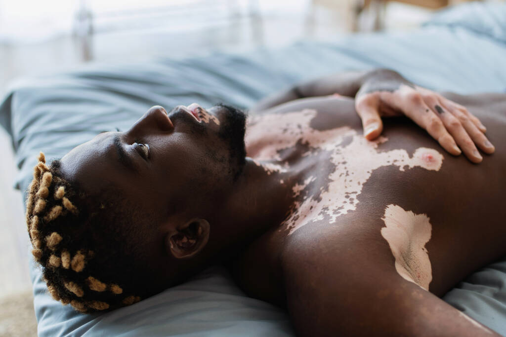 Shirtless african american man with vitiligo resting on bed at home  - Photo, Image