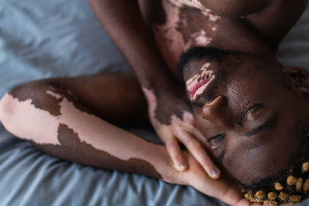 Draufsicht auf hemdslosen afrikanisch-amerikanischen Mann mit Vitiligo schlafen auf dem Bett  - Foto, Bild