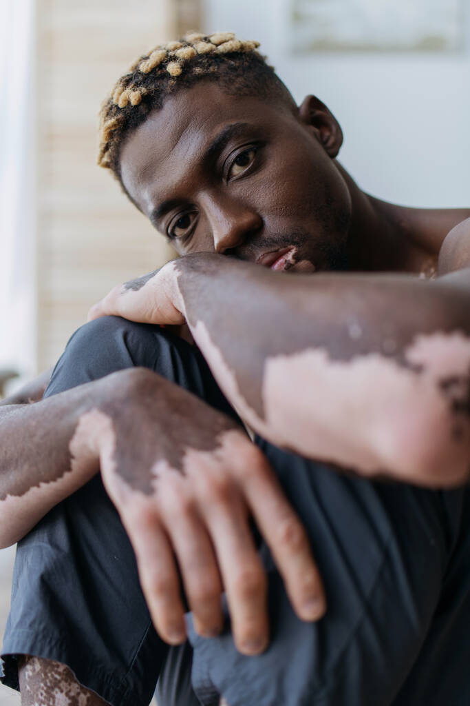 Porträt eines jungen afrikanisch-amerikanischen Mannes mit Vitiligo, der zu Hause in die Kamera schaut  - Foto, Bild