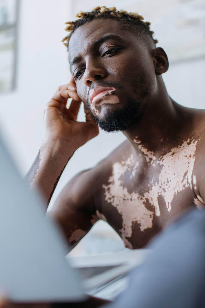 Focalizzato uomo afroamericano con vitiligine utilizzando computer portatile offuscata a casa  - Foto, immagini