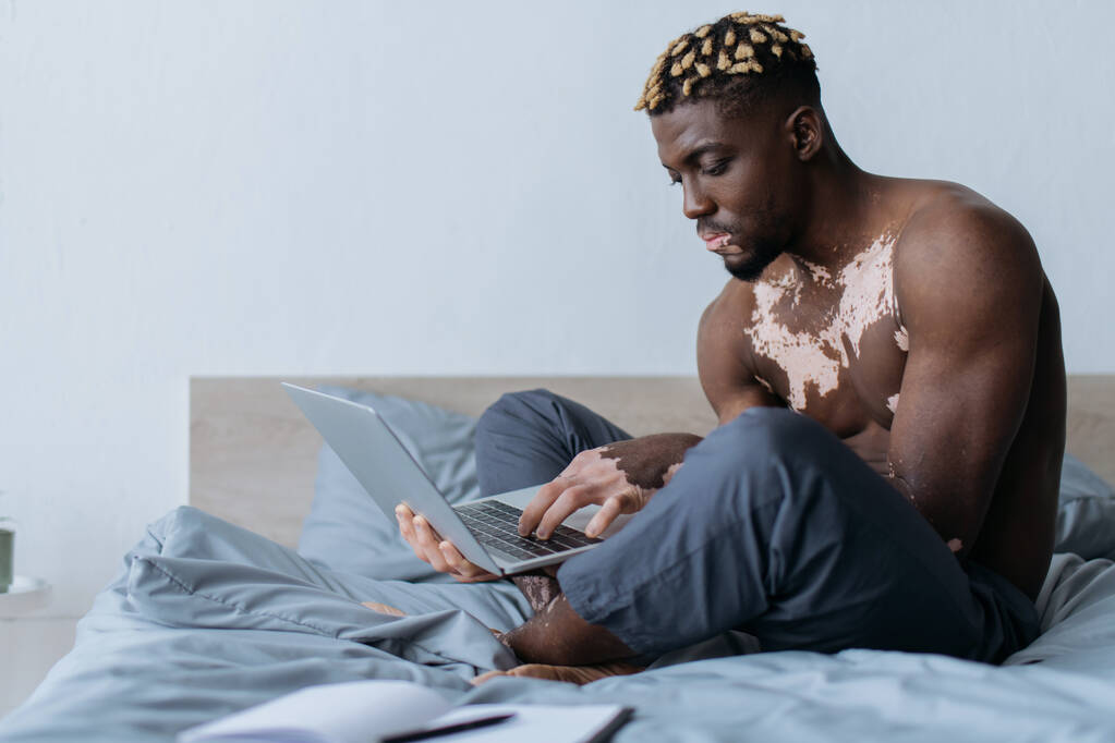 Homem americano africano muscular com vitiligo trabalhando no laptop na cama  - Foto, Imagem