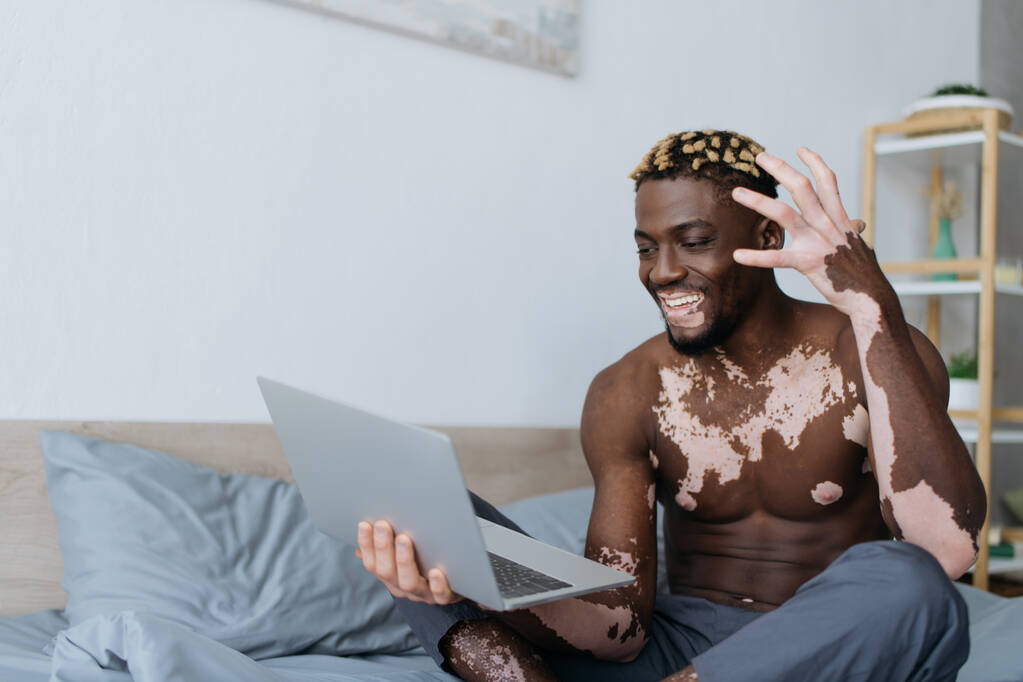 Homme afro-américain insouciant avec vitiligo ayant chat vidéo sur ordinateur portable dans la chambre  - Photo, image