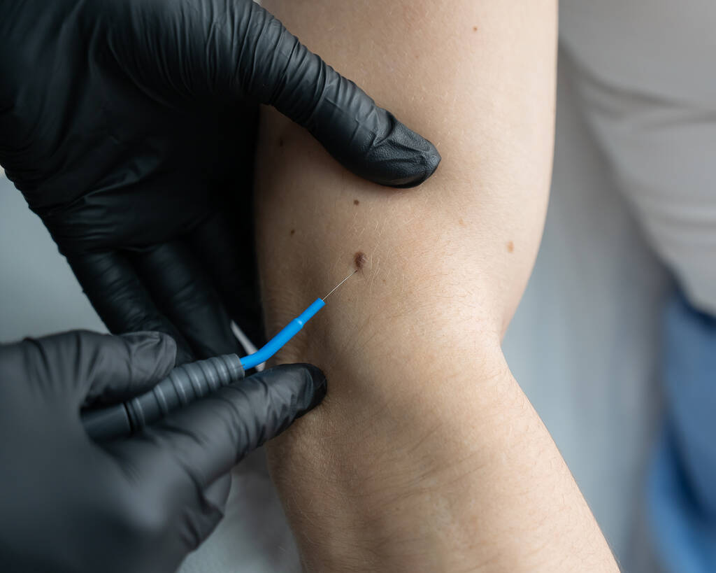 Dermatologist removes a mole on a patients arm using an electrocoagulator - Foto, imagen