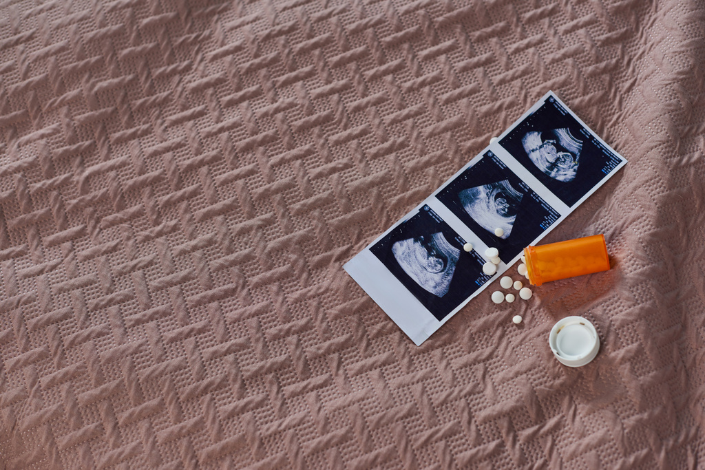 vista dall'alto del flacone con pillole, ultrasuoni, nascituro, contraccezione, camera da letto, concetto di aborto - Foto, immagini