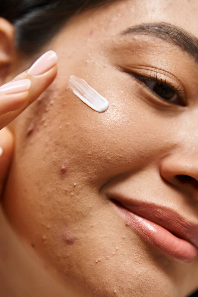primer plano disparo de joven mujer asiática con problemas de piel aplicación de crema de tratamiento del acné en la cara, vertical - Foto, imagen