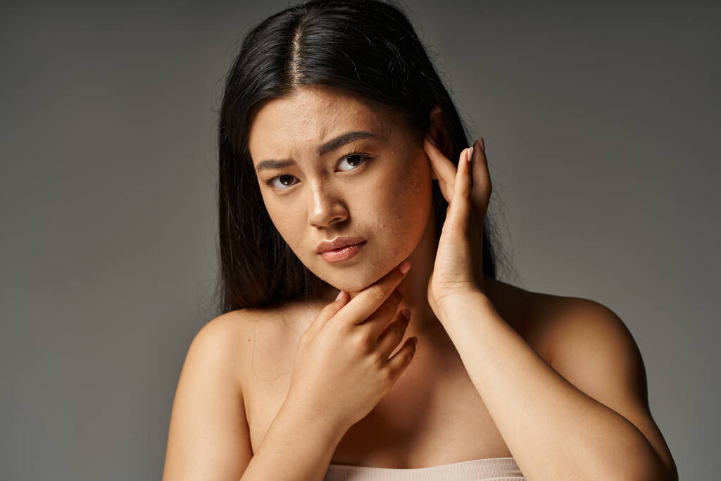 preoccupato giovane donna asiatica con spalle nude e acne incline pelle su sfondo grigio, problemi di pelle - Foto, immagini