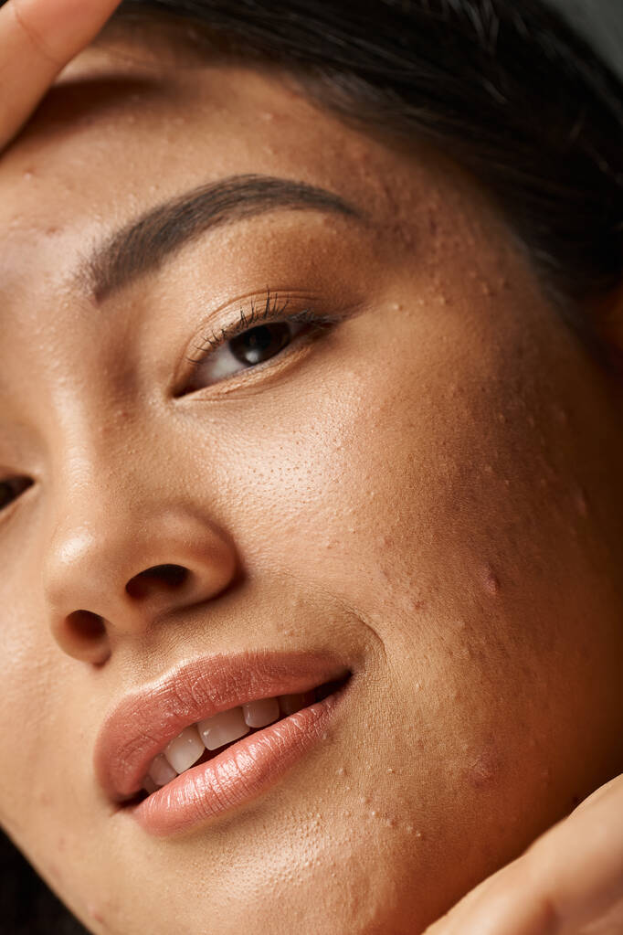 primer plano foto de joven mujer asiática con acné propenso a la piel mirando a la cámara, problemas de la piel concepto - Foto, imagen