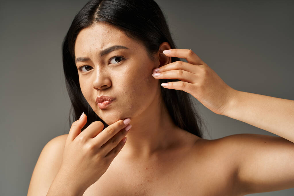 znepokojený mladý asijské žena s holými rameny dotýkat se její tvář s akné na šedém pozadí - Fotografie, Obrázek