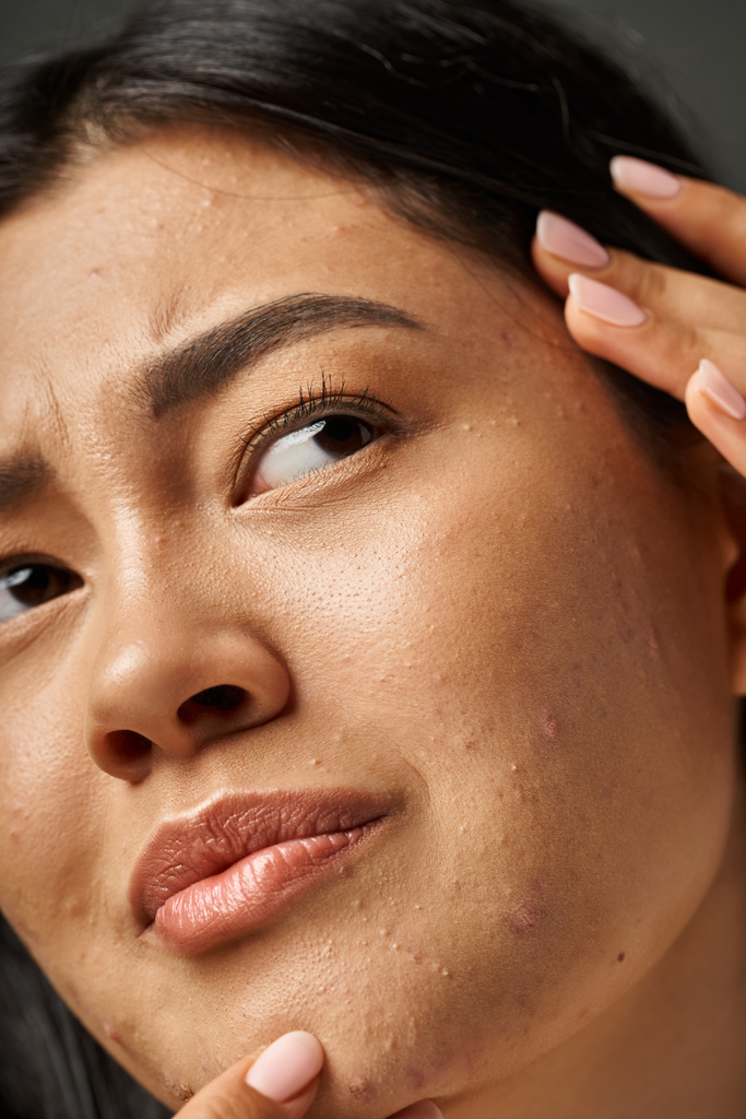 Nahaufnahme von besorgten jungen asiatischen Frau mit brünetten Haaren berührt ihr Gesicht mit Akne - Foto, Bild