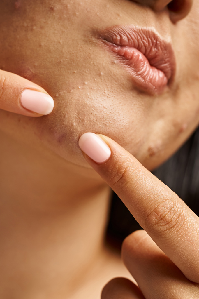 zblízka fotografie oříznuté mladé ženy s akné náchylné kůže praskání pupínek na obličeji, vertikální výstřel - Fotografie, Obrázek
