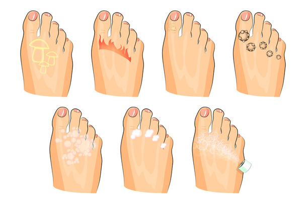 the various injuries of the feet. fungus, burning, warts, sweating. as well as soap, lotion, and spray - Vector, Image