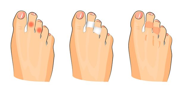 ilustración de callos en los dedos de los pies
 - Vector, imagen