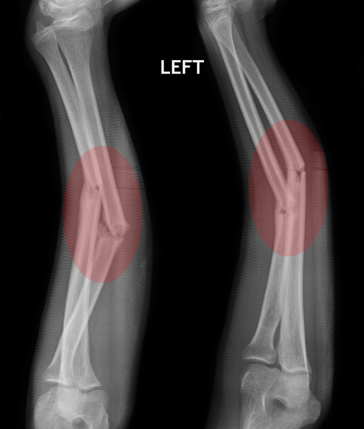 fracture shaft of radius & ulnar bone, x-ray film - Photo, Image