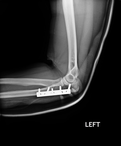 Fratura Cotovelo, imagem de raios-x do antebraço mostrando placa e fixação do parafuso
 - Foto, Imagem