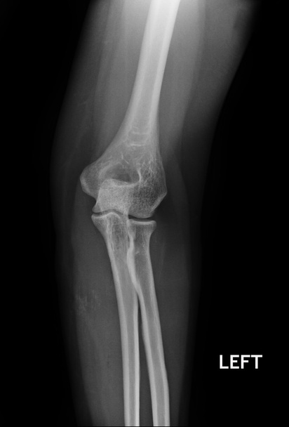 zlomenina lokte, předloktí rentgeny obrazu zobrazeno desku a šroub fixace - Fotografie, Obrázek