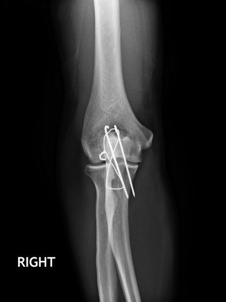 Ellenbogenbruch, Röntgenbild des Unterarms mit Platten- und Schraubenfixierung - Foto, Bild
