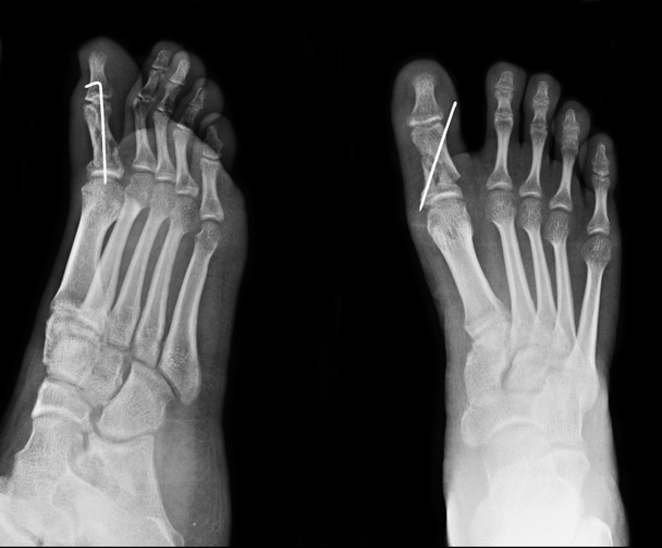 röntgen-láb - Fotó, kép