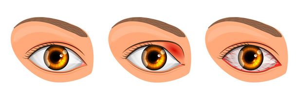 eye suffering from conjunctivitis and styes - Vector, Image