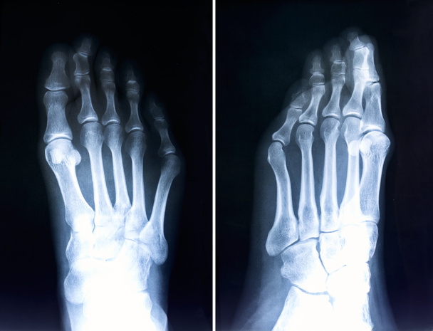 Röntgen láb ujjak. Röntgen deformált ujjakkal. Hallux valg - Fotó, kép