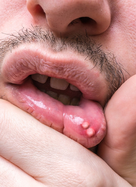 Έλκος επώδυνες άφθες στο στόμα του ανθρώπου. - Φωτογραφία, εικόνα