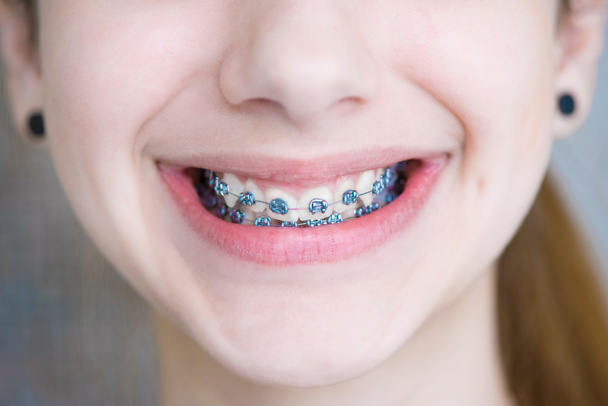 Teeth with braces. - Фото, зображення