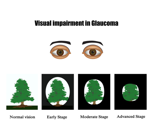 Глаукома. Поле зрения при глаукоме. Инфографика. Векторная иллюстрация на изолированном фоне
 - Вектор,изображение