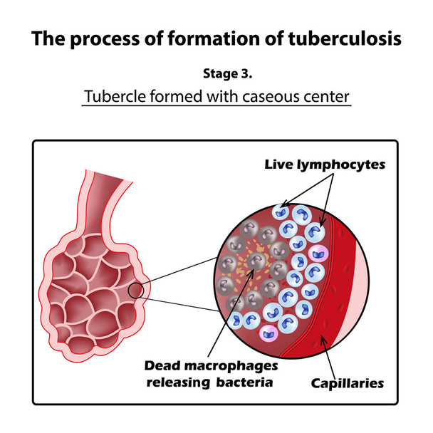 Entwicklung von Tuberkulose. Bühne 3. Infografik. Vektor-Illustration auf isoliertem Hintergrund - Vektor, Bild
