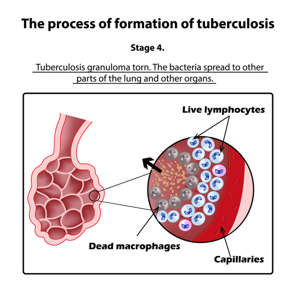 Entwicklung von Tuberkulose. Bühne 4. Infografik. Vektor-Illustration auf isoliertem Hintergrund - Vektor, Bild