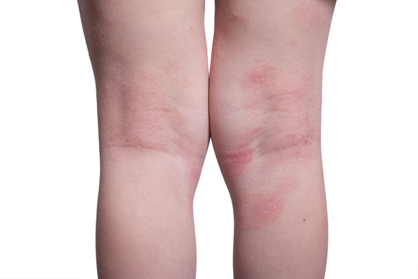 子供の足の湿疹 - 写真・画像