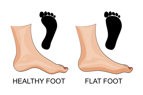 voeten gezond en platte voeten. voetafdruk - Vector, afbeelding