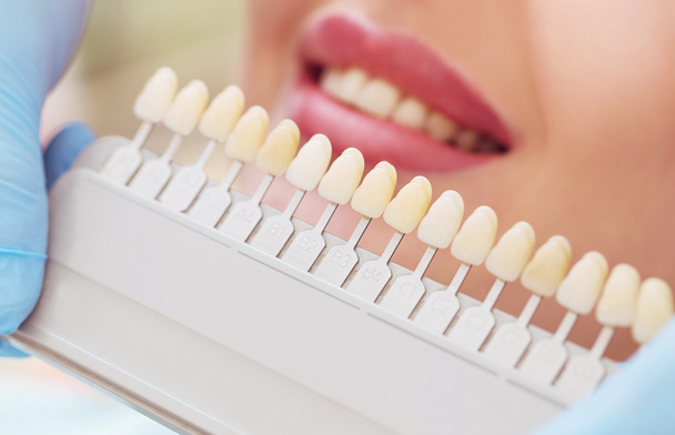Schönes europäisches Frauenlächeln mit gesunder Zahnaufhellung. Zahnpflegekonzept. Set von Implantaten mit verschiedenen Farbtönen - Foto, Bild