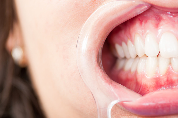 Nahaufnahme des halben Mundes mit Kunststoff-Retraktor und Zähnen - Foto, Bild
