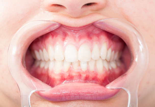 Крупним планом лобовий вигляд жінки білі зуби
 - Фото, зображення