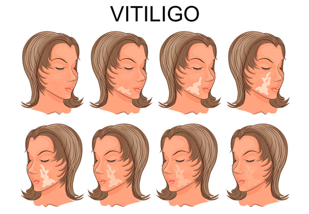 vitiligo léčba. před a po - Vektor, obrázek