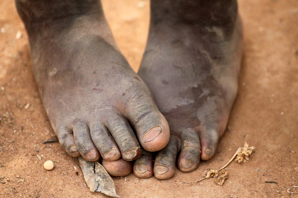 Ноги африканської дитини
 - Фото, зображення