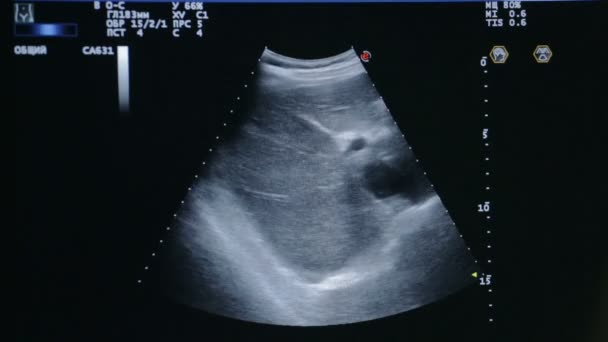 Screening der Ultraschalluntersuchung des Bauches - Filmmaterial, Video