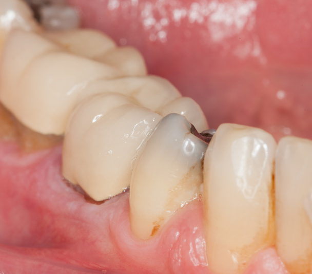 Macro image of filled teeth - Photo, Image