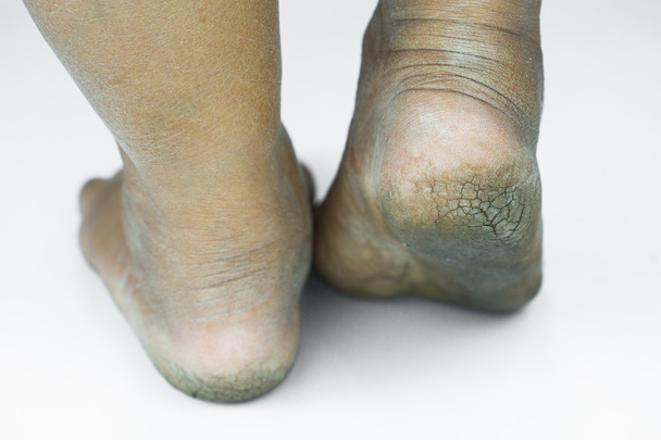pied sale ou talons fissurés isoler sur fond blanc, médical ou pieds santé de la population, centre médical pour les talons ou les pieds
. - Photo, image