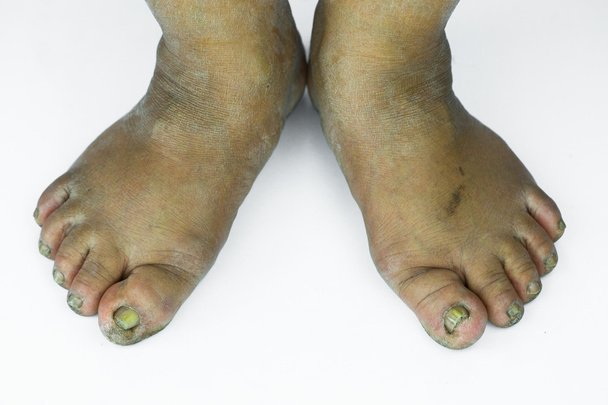 dirty foot or cracked heels isolate on white background, medical or feet health of the people, medical center for heels or feet. - Photo, Image