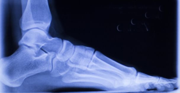 Ayak ve ayak parmakları yaralanma xray tarama - Fotoğraf, Görsel