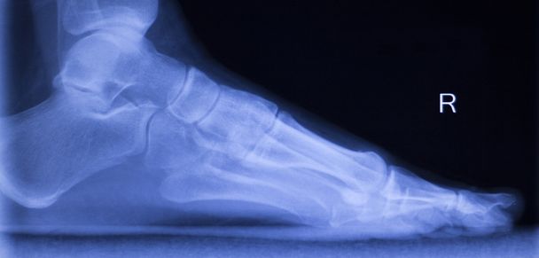 Τα πόδια τακούνι αστράγαλο ζημία xray σάρωση - Φωτογραφία, εικόνα