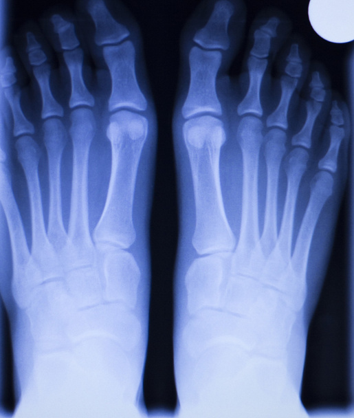 Пошкодження ніг і ніг рентгенівське сканування
 - Фото, зображення