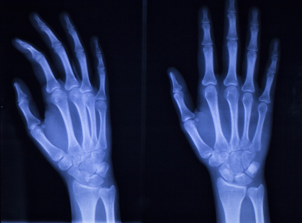 Hand fingers thumb wrist xray scan - Photo, Image