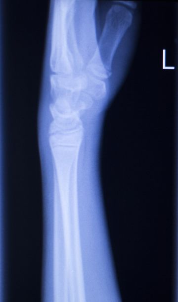 Forearm arm and elbow xray scan - Photo, Image