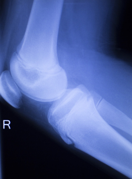 Lesión de rodilla y menisco Tomografía de rayos X
 - Foto, imagen